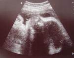 Before Birth