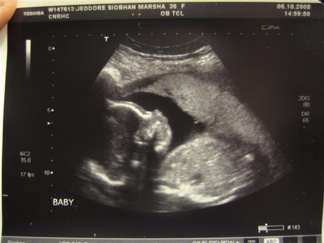 Jeddore Baby Ultrasound 2008